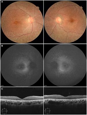 A novel RPE65 variant p.(Ala391Asp) in Leber congenital amaurosis: a case report and literature review in Japan